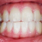 Parodontitis: Schade aan weefsel & bot die tand ondersteunen